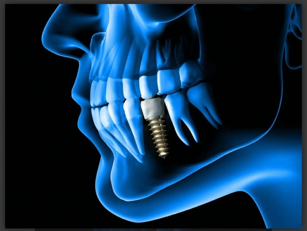 dental implant